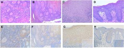 Expression of PD-L1 and p-RPS6 in epithelial dysplasia and squamous cell carcinoma of the oral cavity